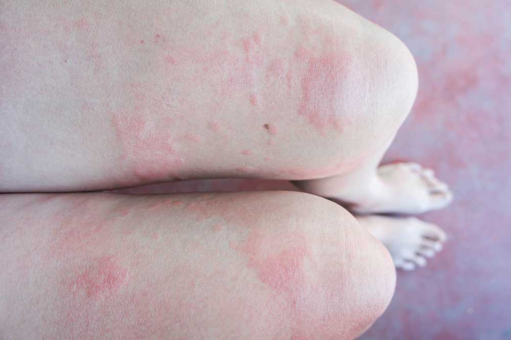 AAACOD-Allergy-Hives-Legs