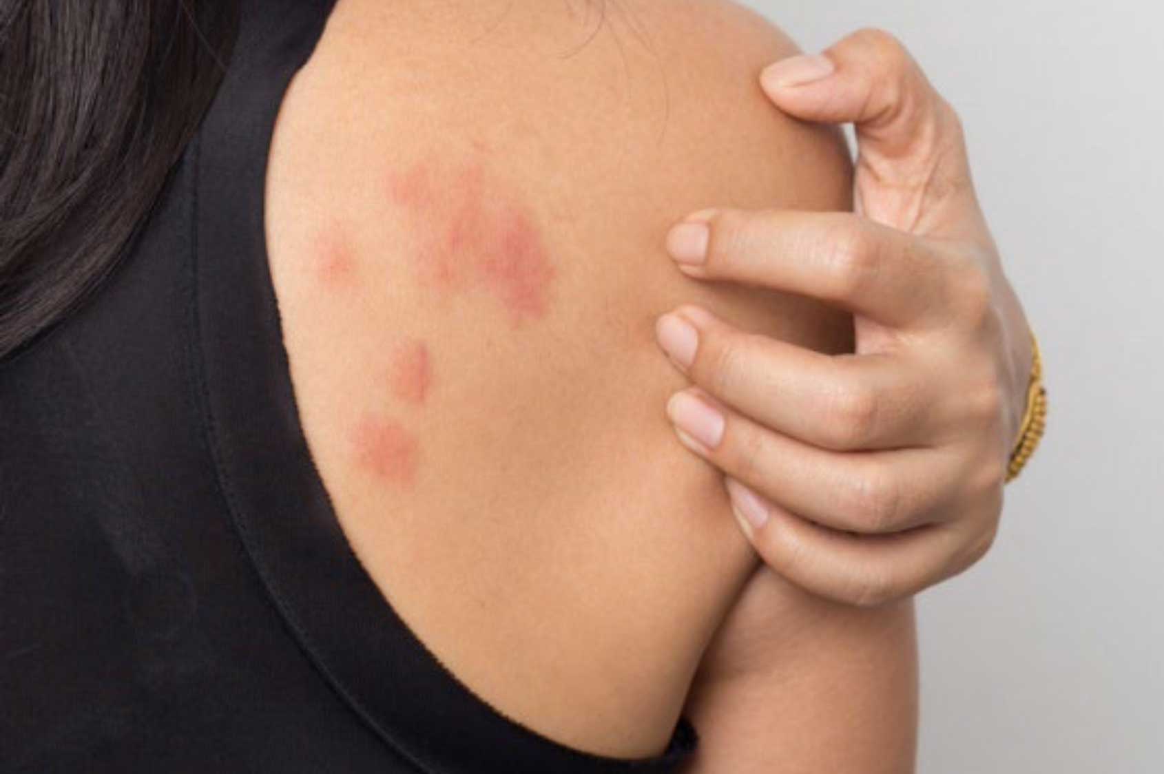 AAACOD-Allergy-Hives-Treatment