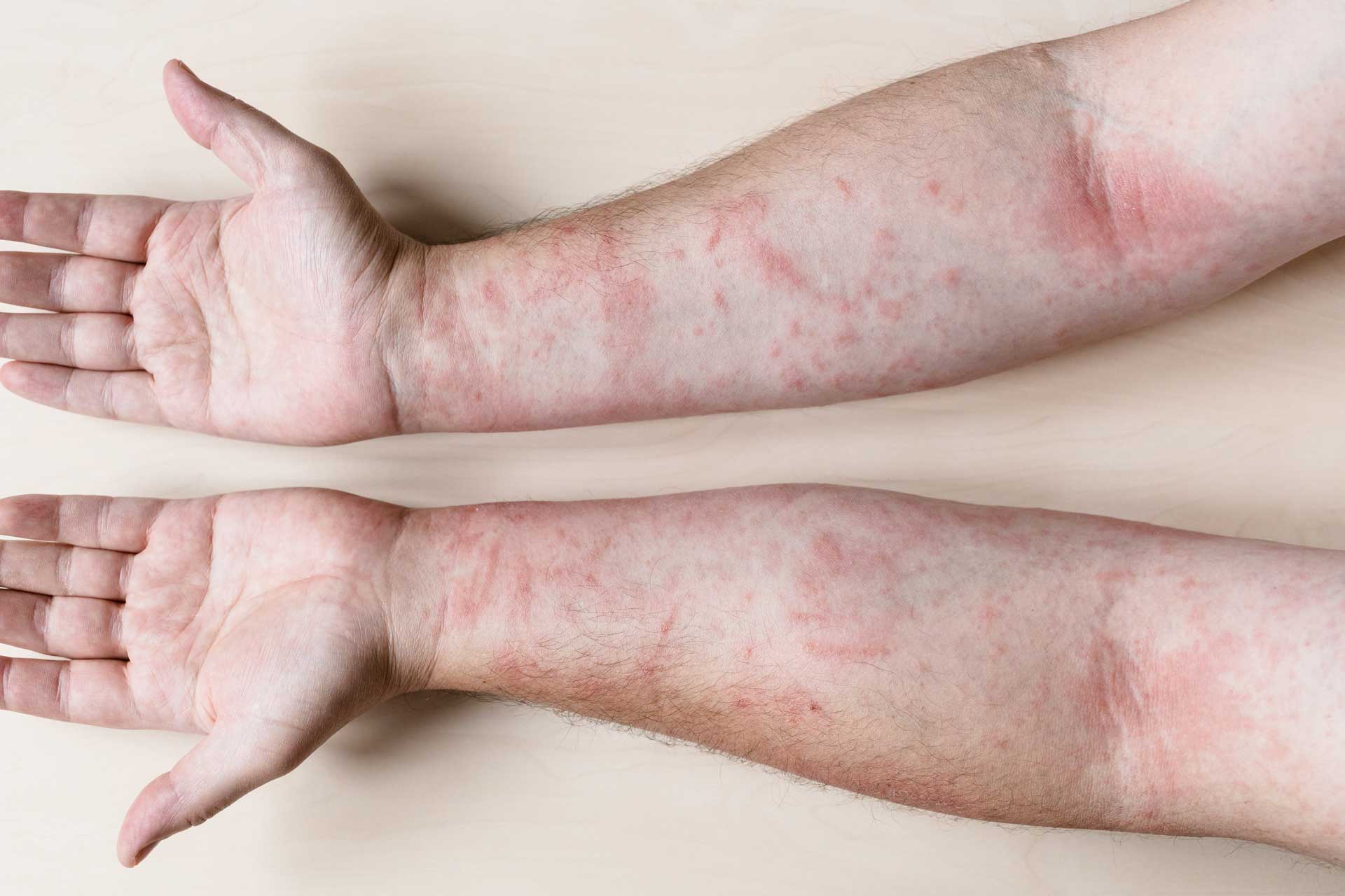 AAACOD-Allergy-Skin-Hives